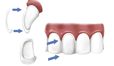 implant dentar fatete
