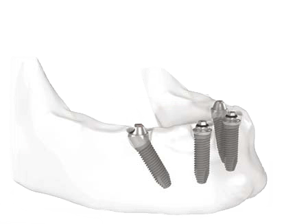Implant dentar unirii